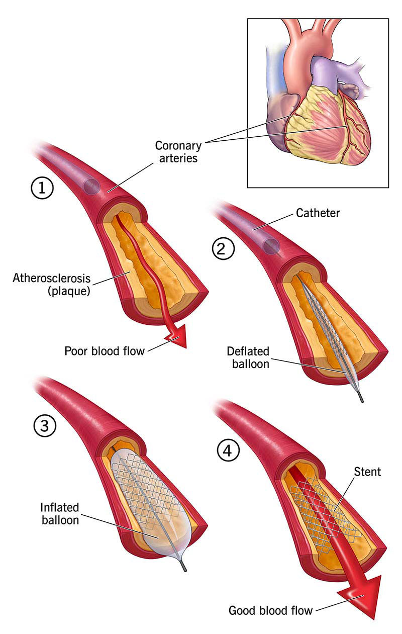 Coronary interventions - Houston Cardiovascular Care